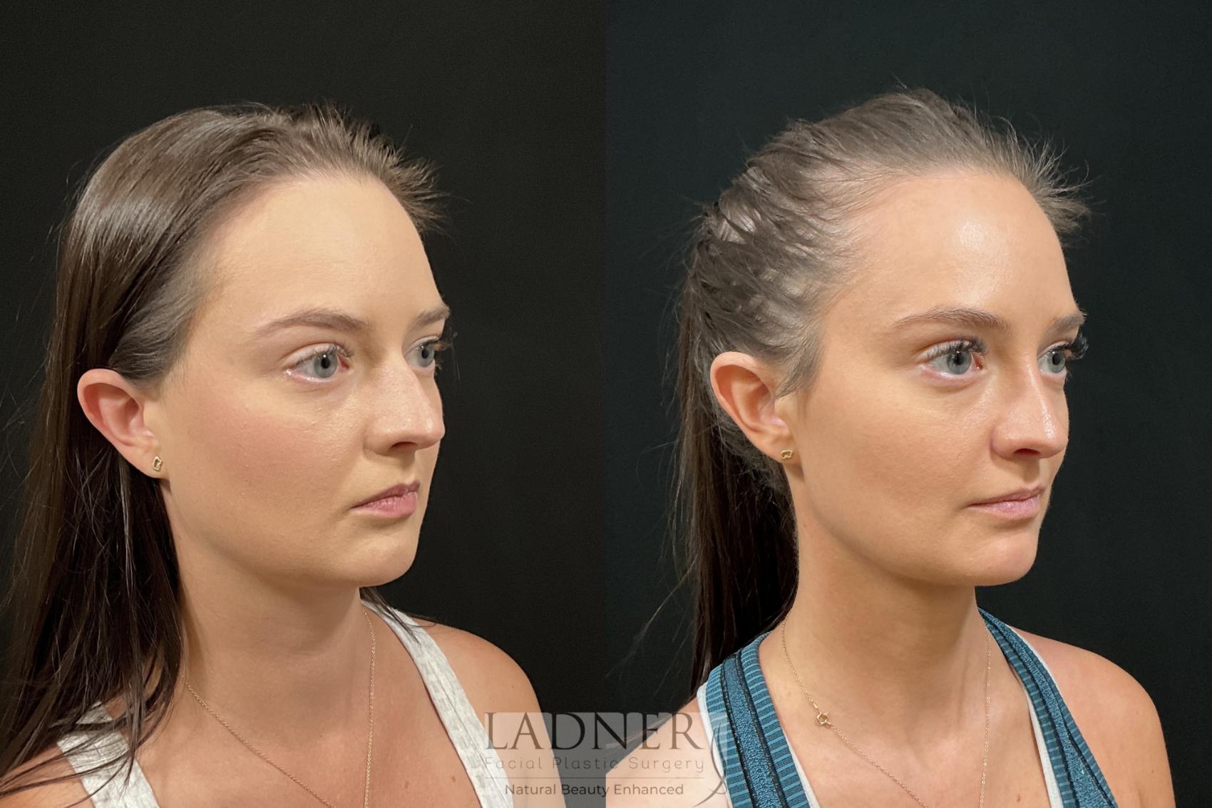 Before and After Image: Rhinoplasty - right-front-oblique