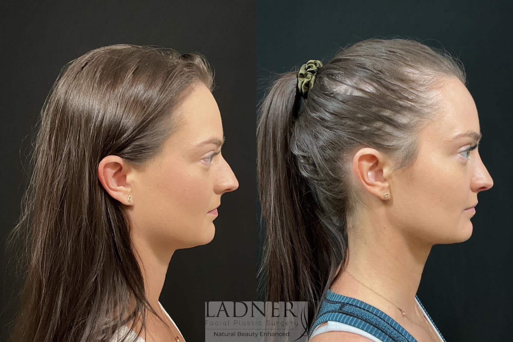 Before and After Image: Rhinoplasty - right-side