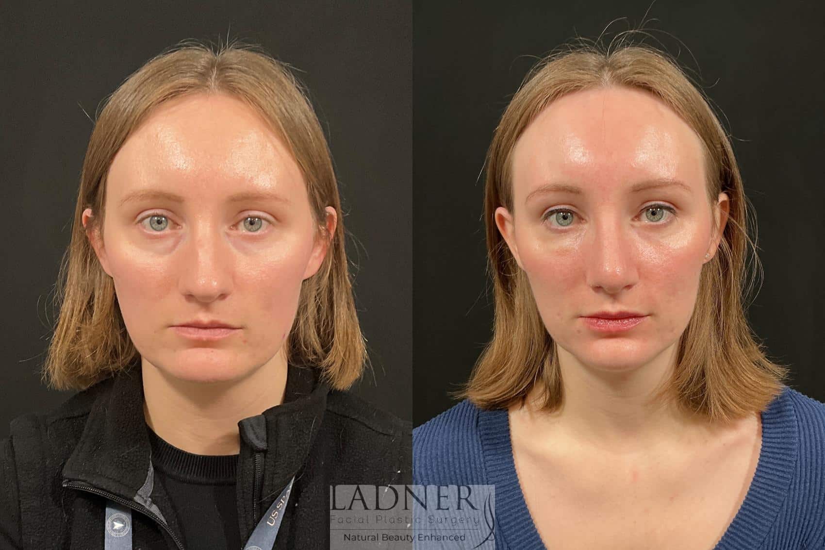 Before and After Image: Rhinoplasty - front