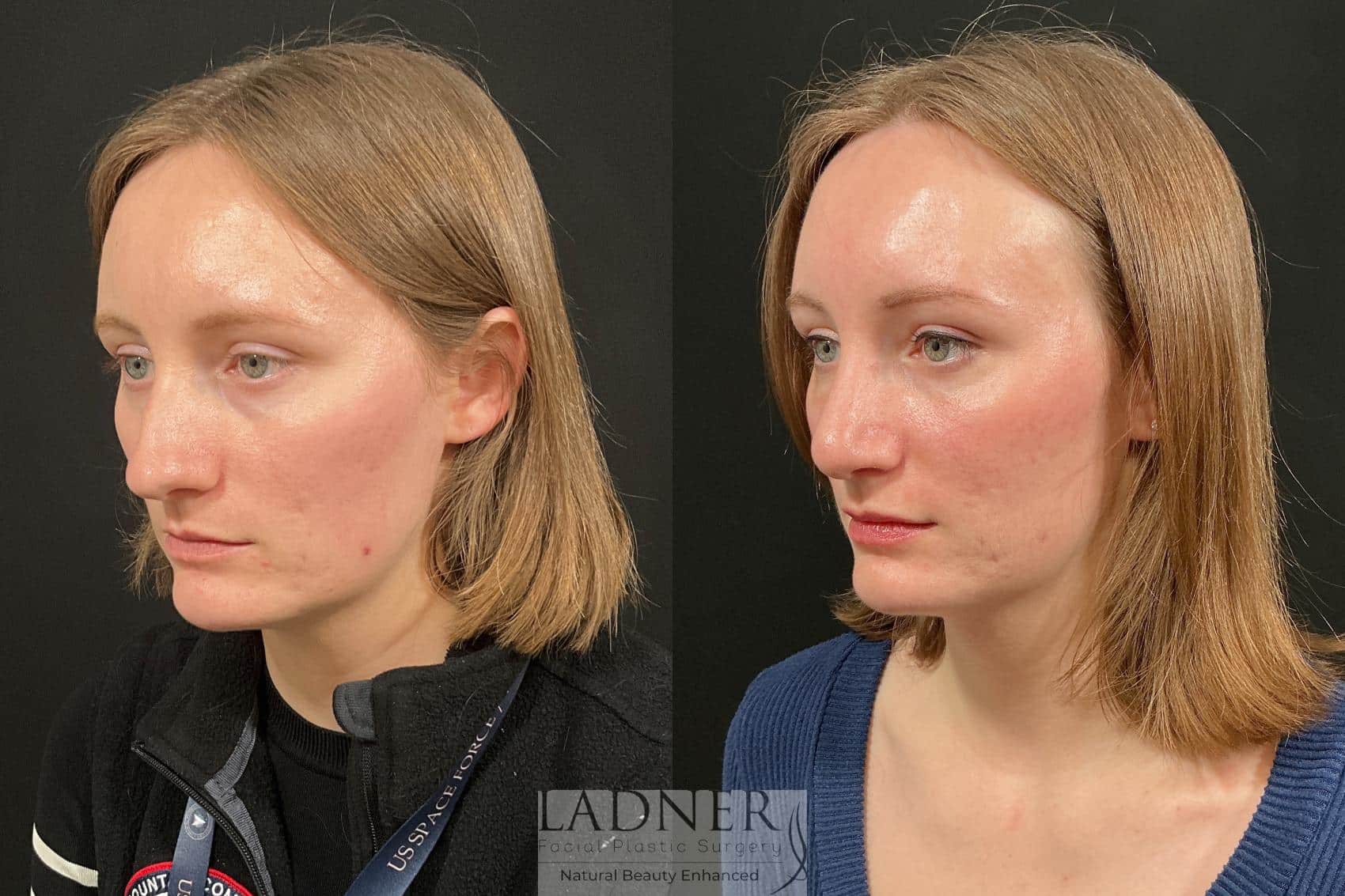 Before and After Image: Rhinoplasty - left-front-oblique