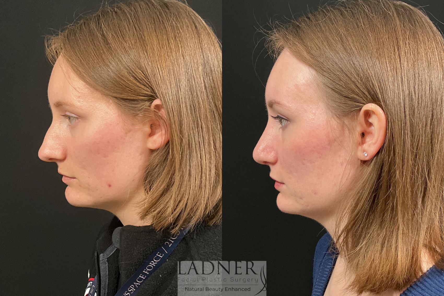 Before and After Image: Rhinoplasty - left-side