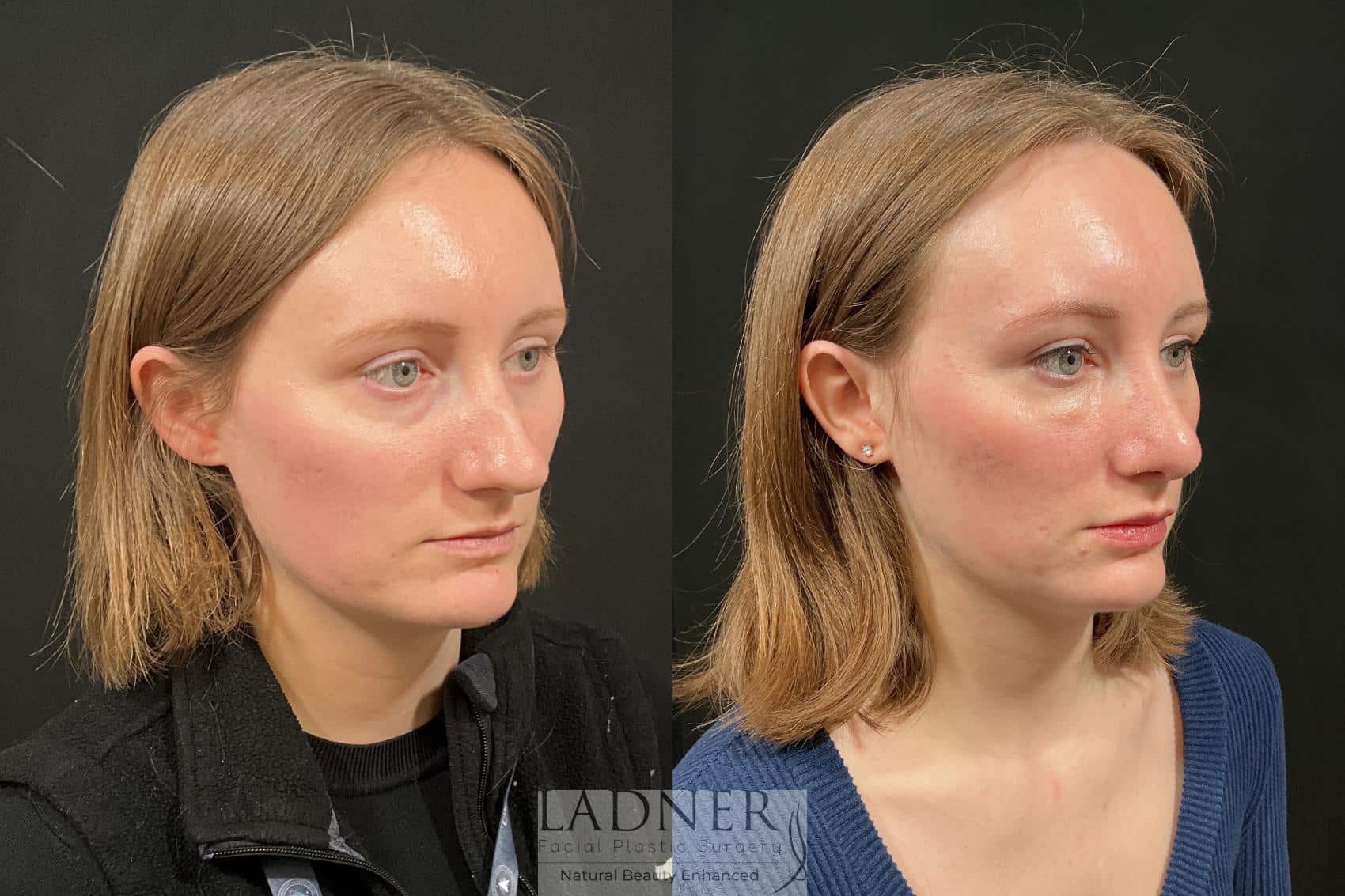 Before and After Image: Rhinoplasty - right-front-oblique