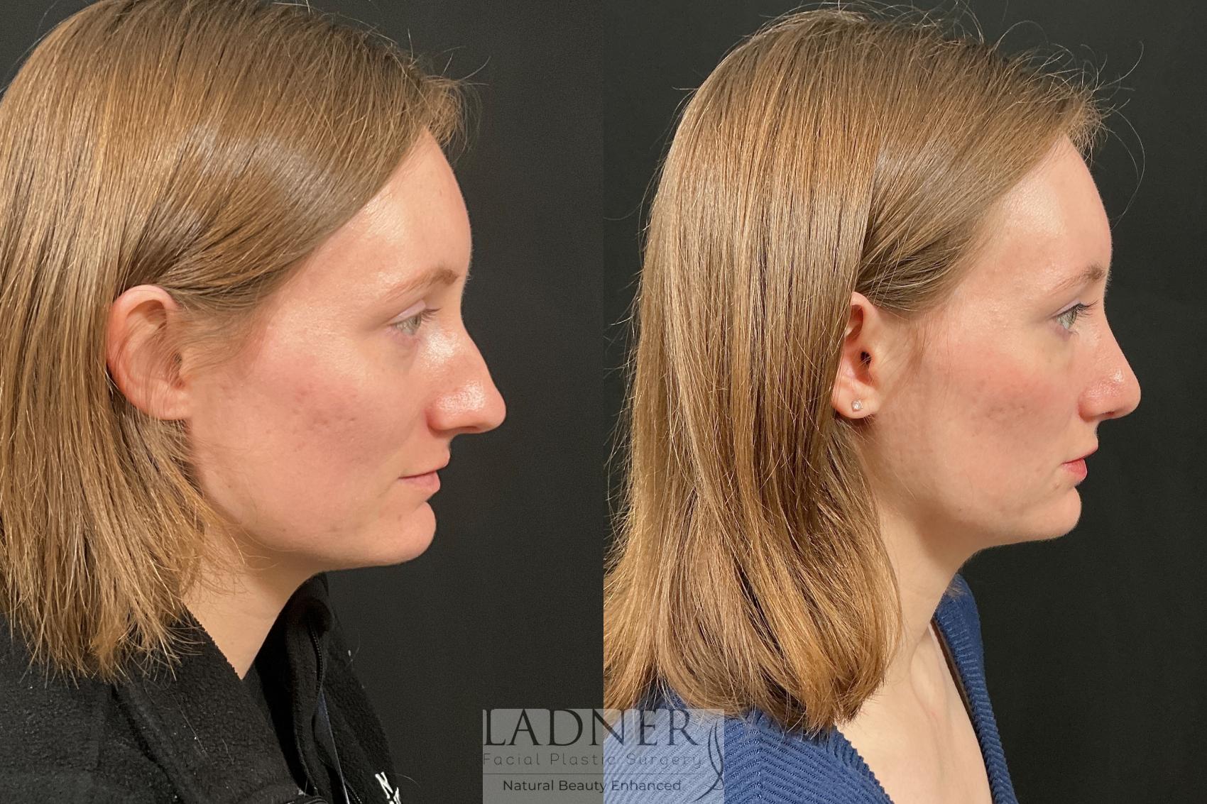 Before and After Image: Rhinoplasty - right-side