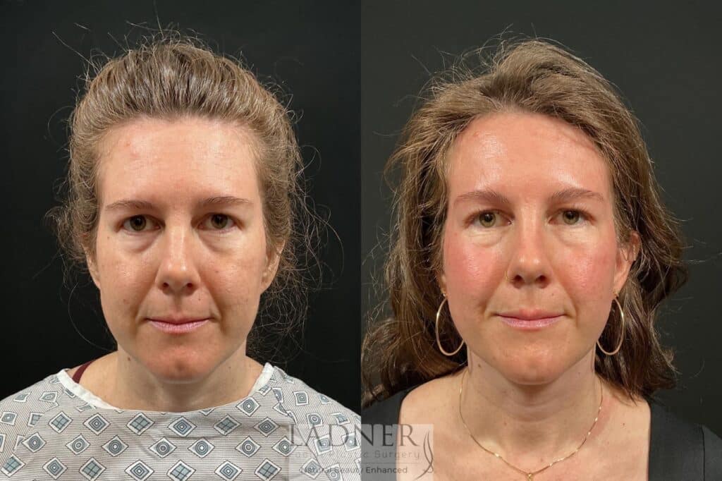 Before and After Image: Brow Lift - front