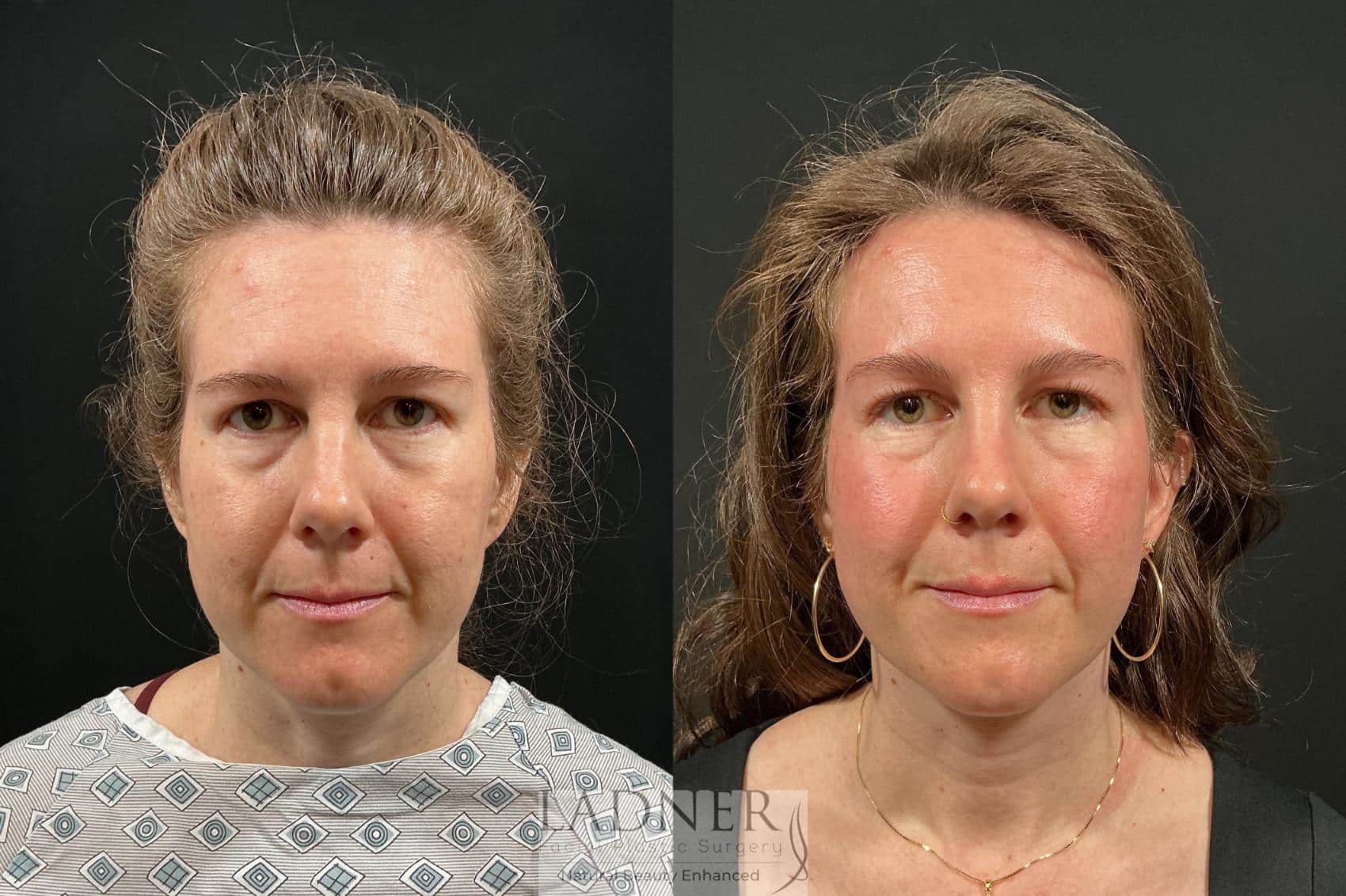 Before and After Image: Brow Lift - front