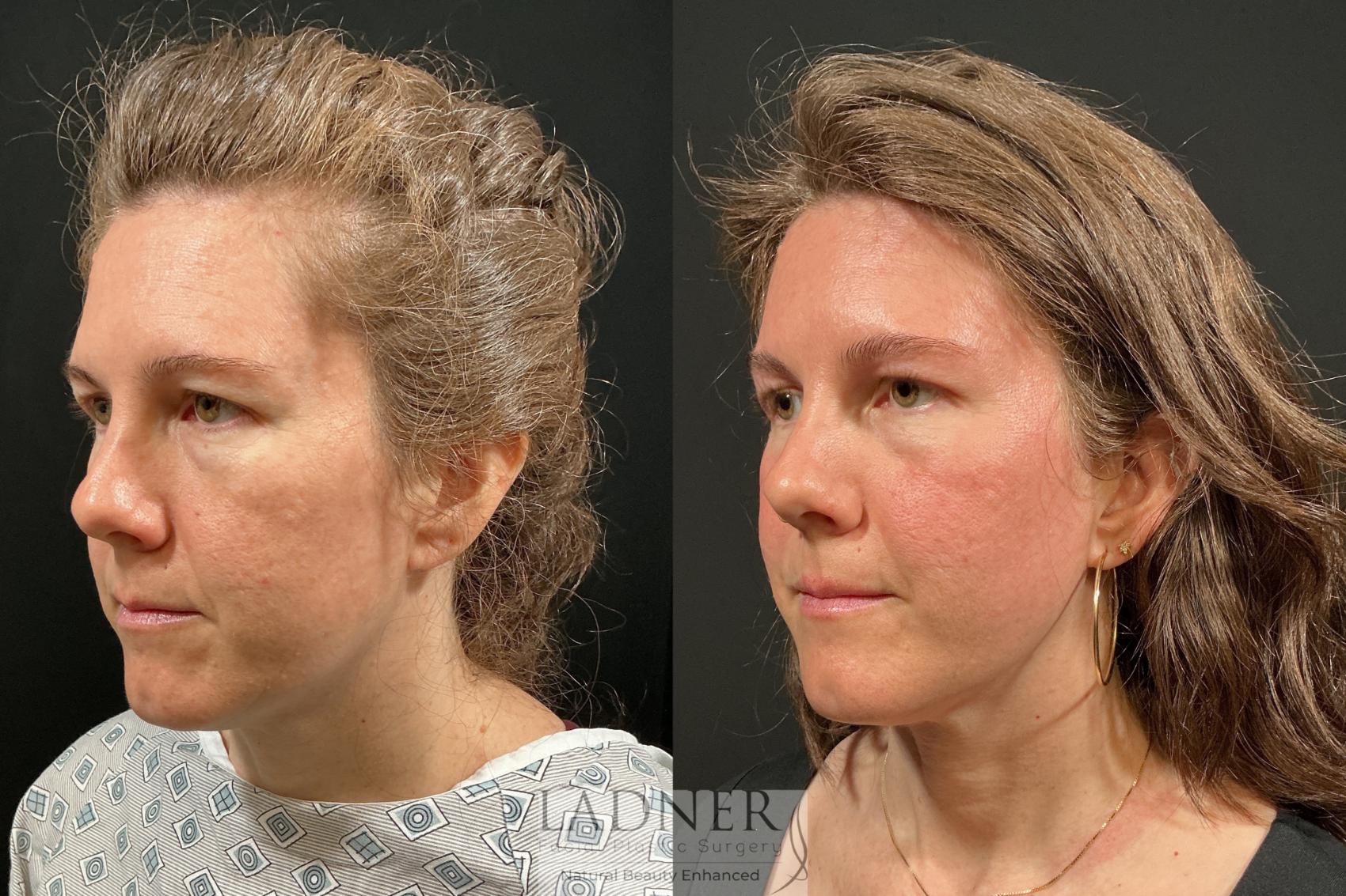 Before and After Image: Brow Lift - left-front-oblique
