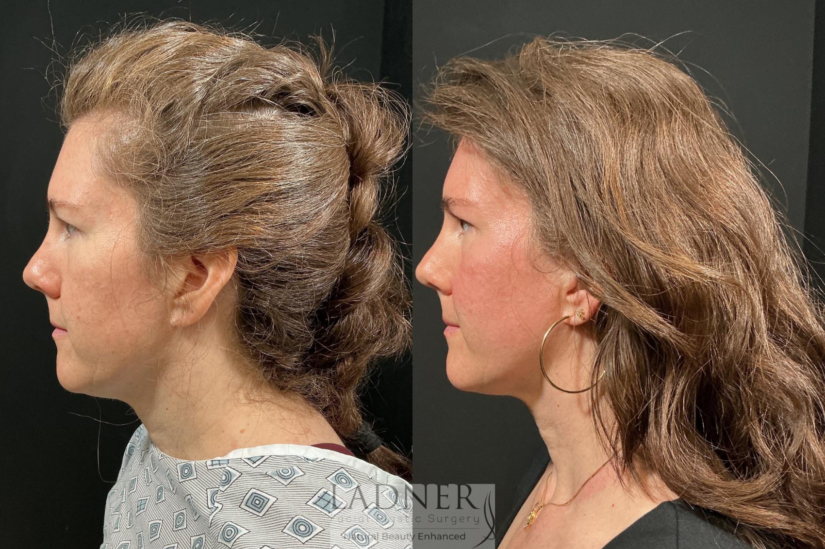 Before and After Image: Brow Lift - left-side