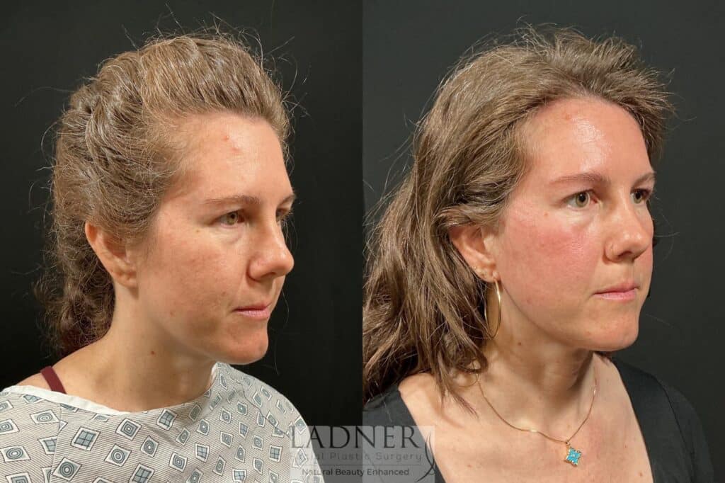 Before and After Image: Brow Lift - right-front-oblique