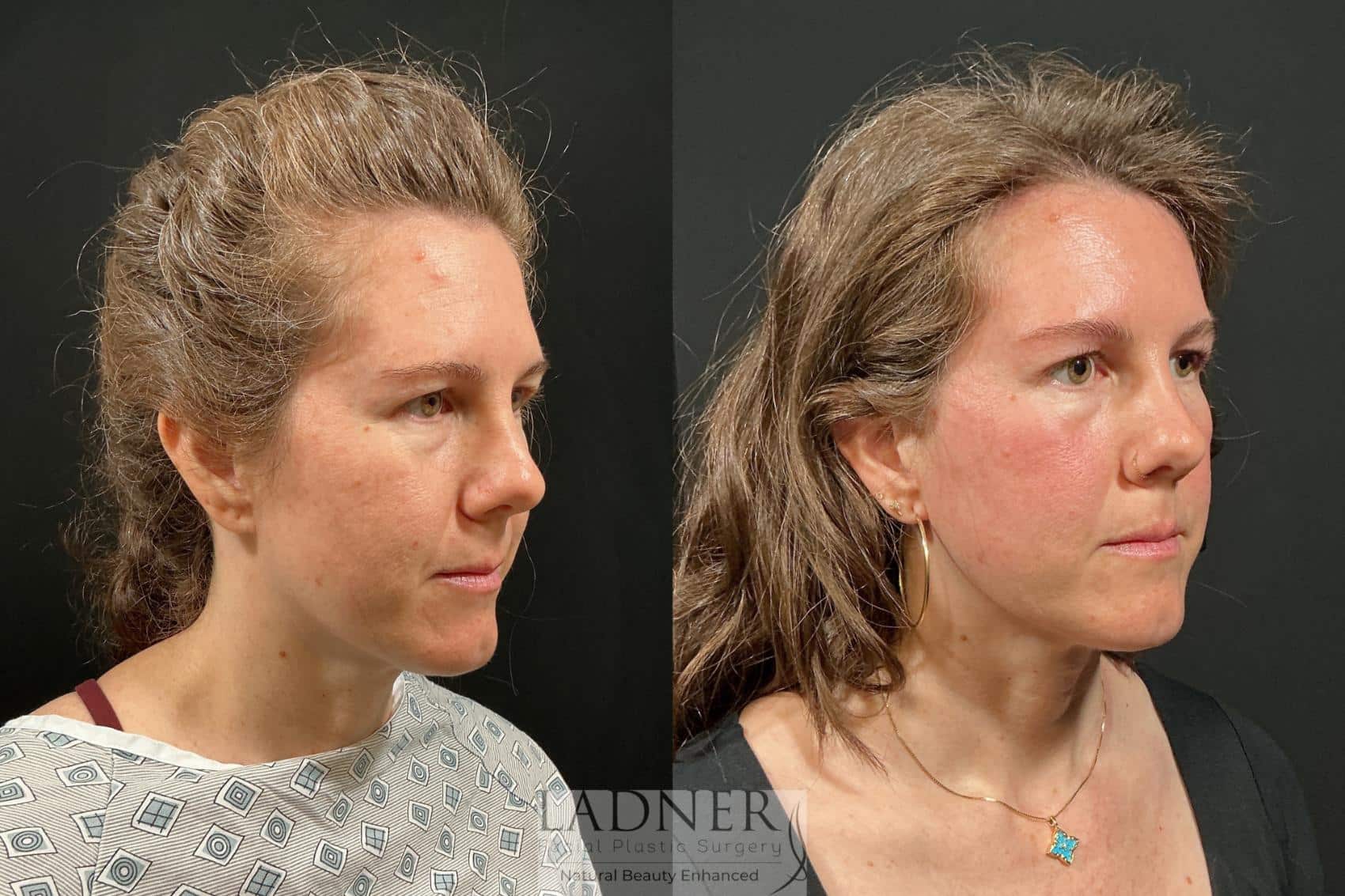 Before and After Image: Brow Lift - right-front-oblique