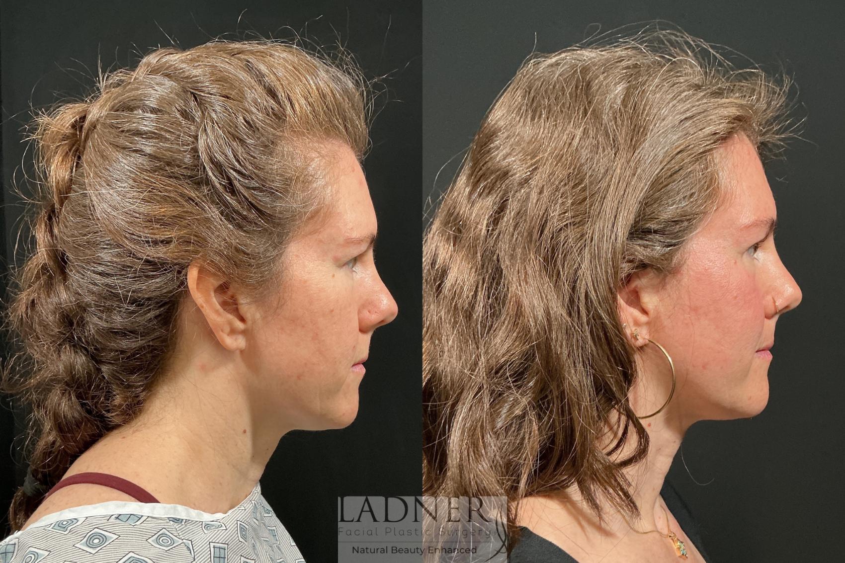 Before and After Image: Brow Lift - right-side