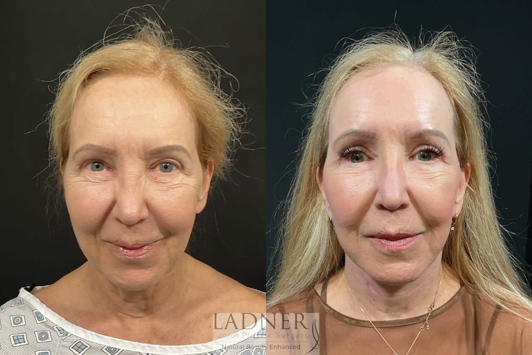 Before and After Image: Deep Plane Facelift, Deep Plane Neck Lift, Revision Upper Blepharoplasty, Fat Transfer to Lower Eyelids Medial Cheeks, and CO2 Laser Resurfacing - front