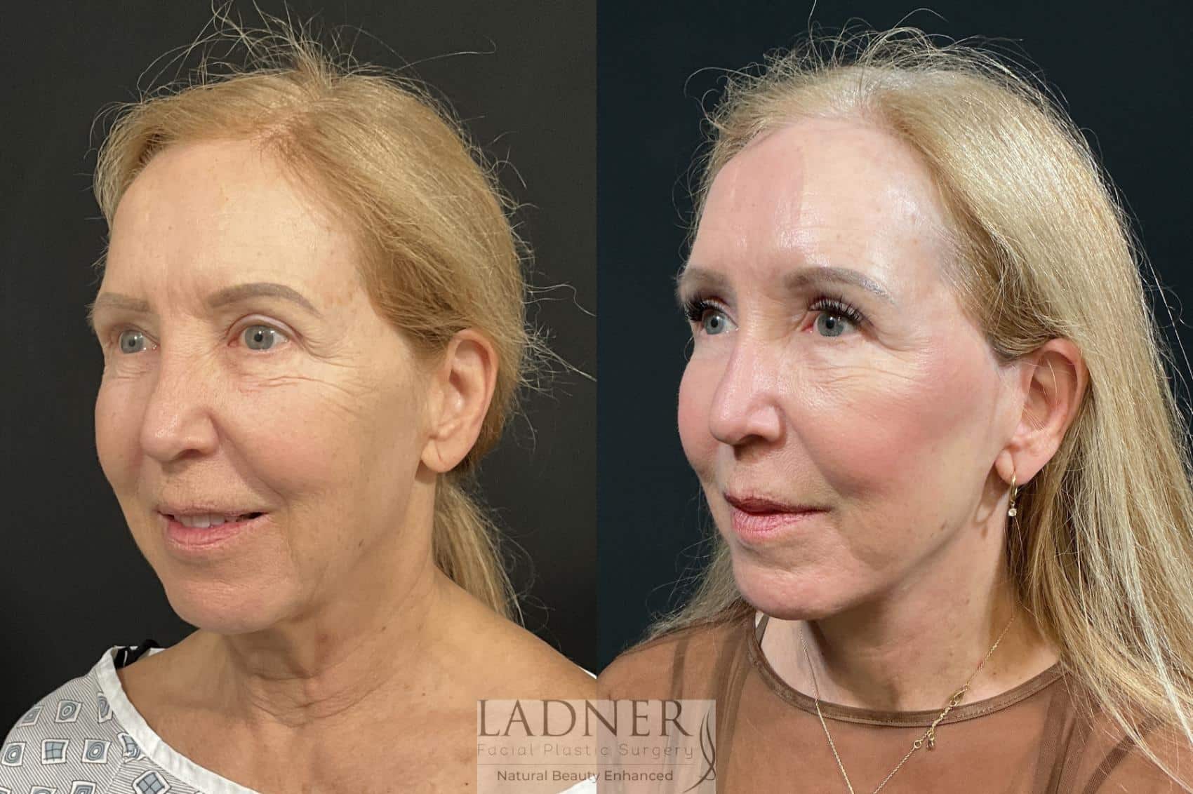 Before and After Image: Deep Plane Facelift, Deep Plane Neck Lift, Revision Upper Blepharoplasty, Fat Transfer to Lower Eyelids Medial Cheeks, and CO2 Laser Resurfacing - left-front-oblique