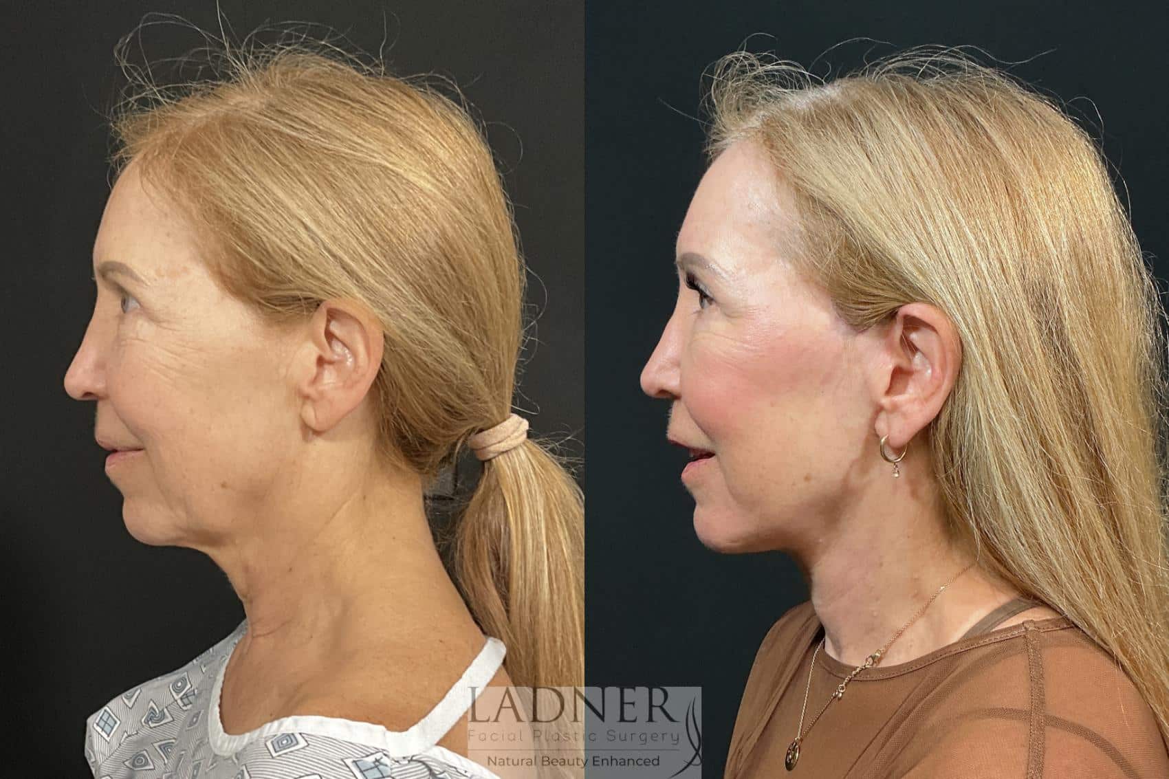 Before and After Image: Deep Plane Facelift, Deep Plane Neck Lift, Revision Upper Blepharoplasty, Fat Transfer to Lower Eyelids Medial Cheeks, and CO2 Laser Resurfacing - left-side