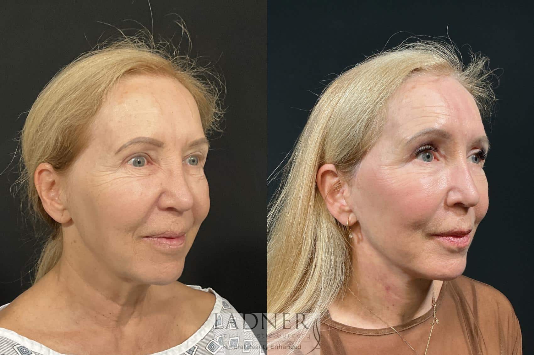 Before and After Image: Deep Plane Facelift, Deep Plane Neck Lift, Revision Upper Blepharoplasty, Fat Transfer to Lower Eyelids Medial Cheeks, and CO2 Laser Resurfacing - right-front-oblique