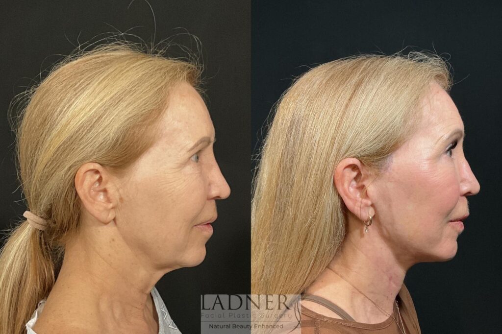 Before and After Image: Deep Plane Facelift, Deep Plane Neck Lift, Revision Upper Blepharoplasty, Fat Transfer to Lower Eyelids Medial Cheeks, and CO2 Laser Resurfacing - right-side