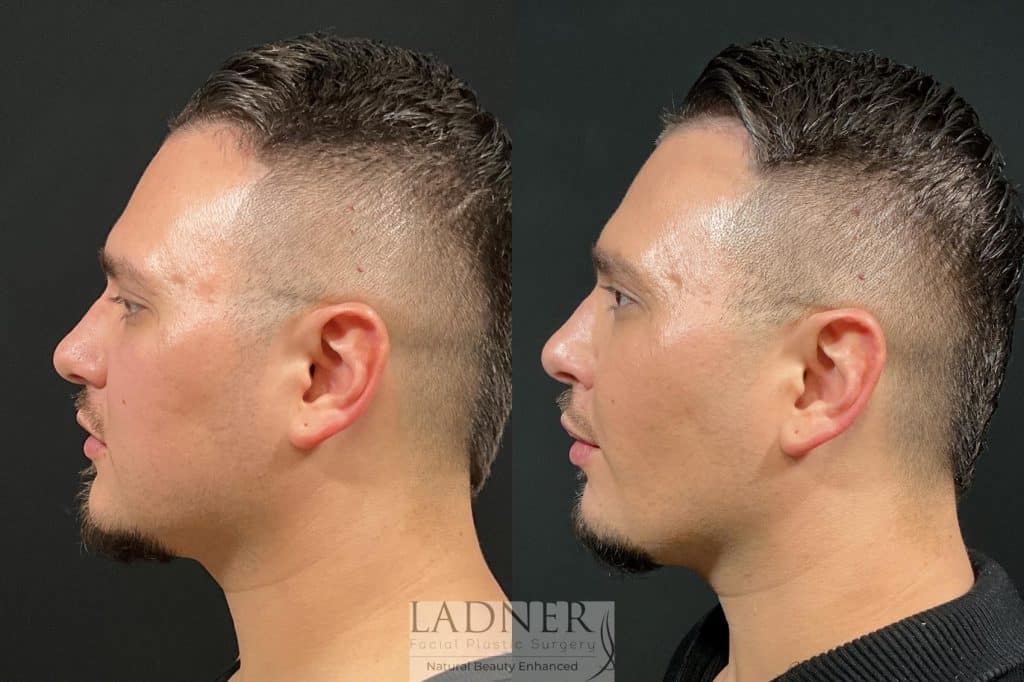 Before and After Image: Buccal Fat Removal & Facial Plastic Surgery for Men - left-side