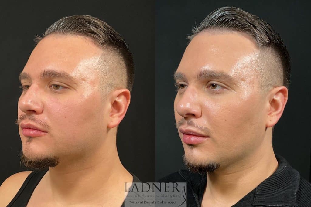 Before and After Image: Buccal Fat Removal & Facial Plastic Surgery for Men - left-front-oblique