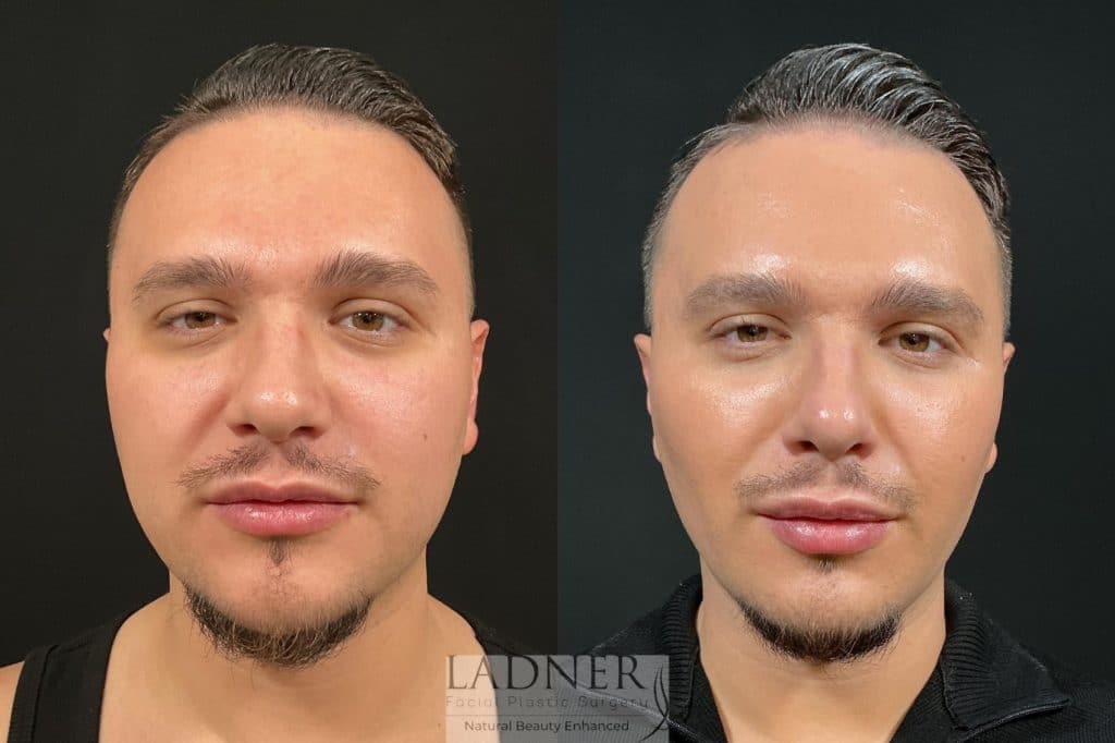 Before and After Image: Buccal Fat Removal & Facial Plastic Surgery for Men - front