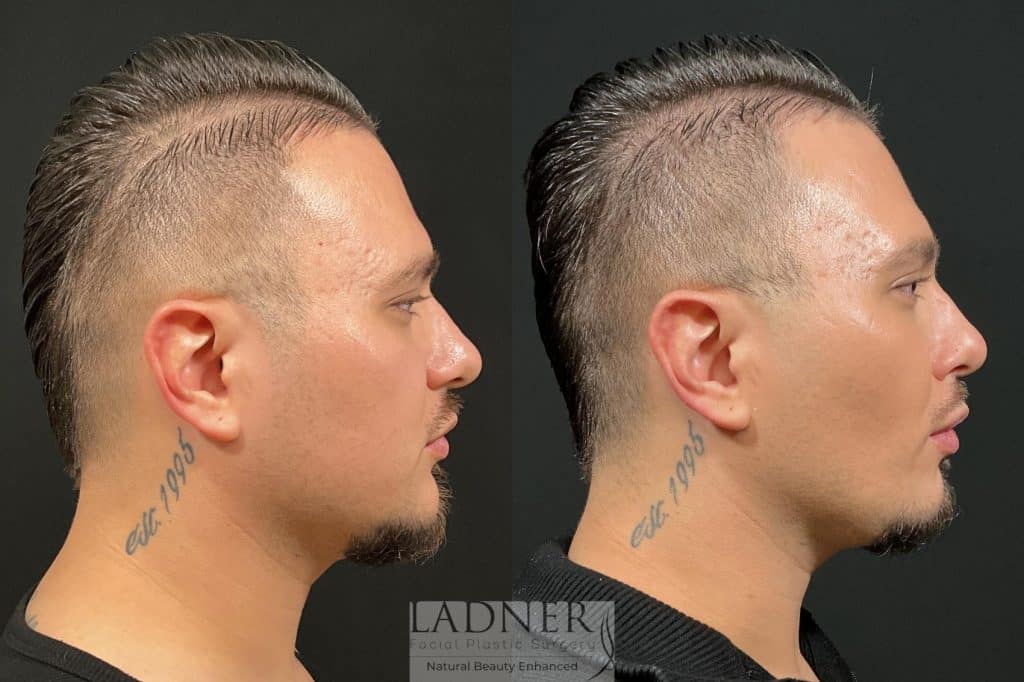 Before and After Image: Buccal Fat Removal & Facial Plastic Surgery for Men - right-side