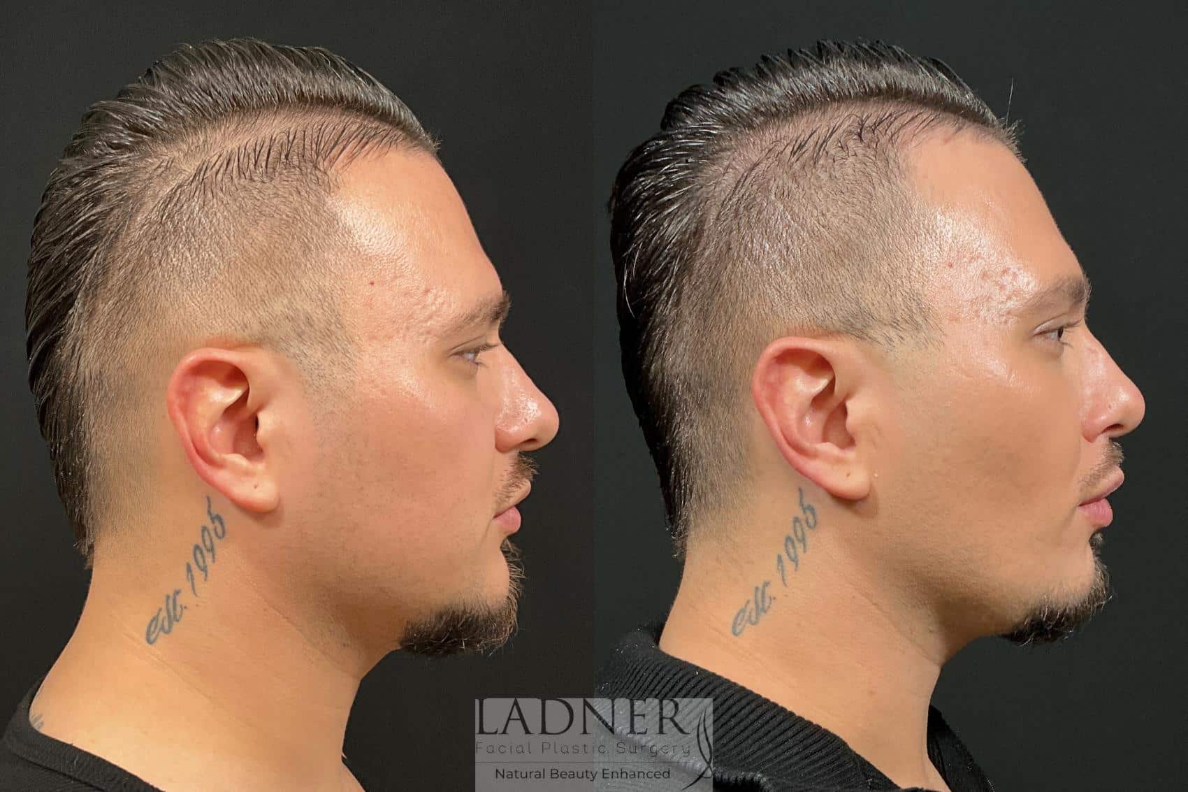 Before and After Image: Buccal Fat Pad Removal - right-side