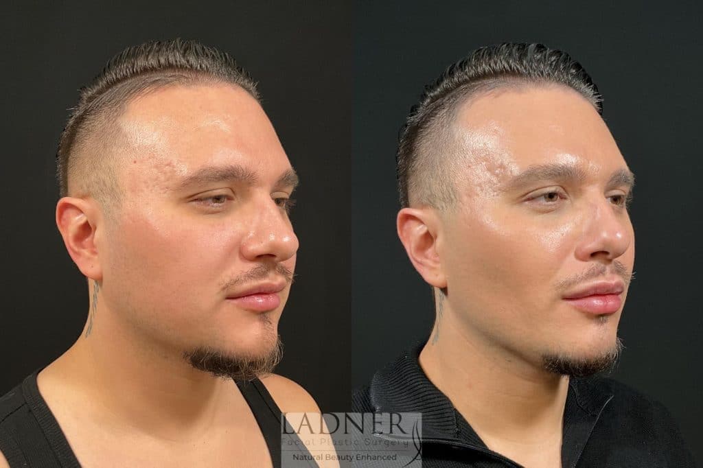 Before and After Image: Buccal Fat Removal & Facial Plastic Surgery for Men - right-front-oblique