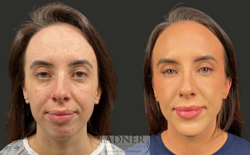 Before and After Image: Chin Augmentation & Rhinoplasty - front