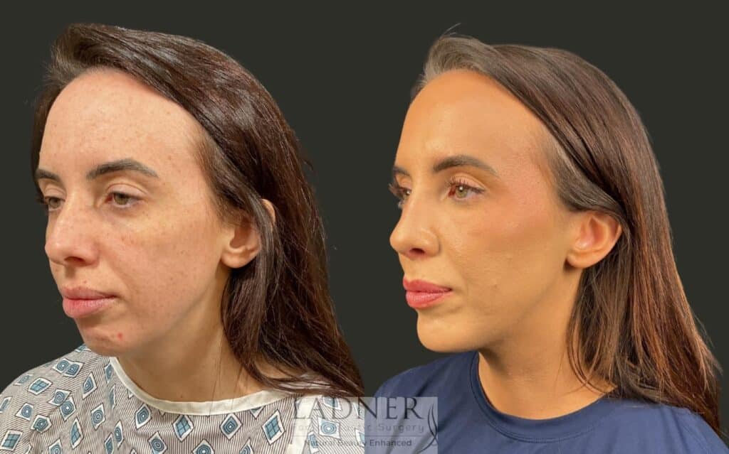 Before and After Image: Chin Augmentation & Rhinoplasty - left-front-oblique
