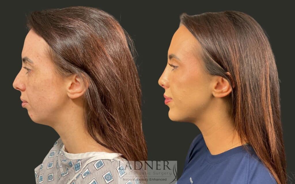 Before and After Image: Chin Augmentation & Rhinoplasty - left-side