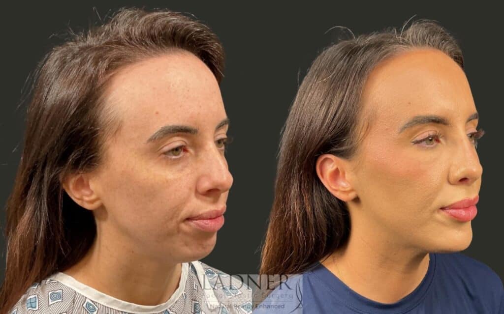 Before and After Image: Chin Augmentation & Rhinoplasty - right-front-oblique