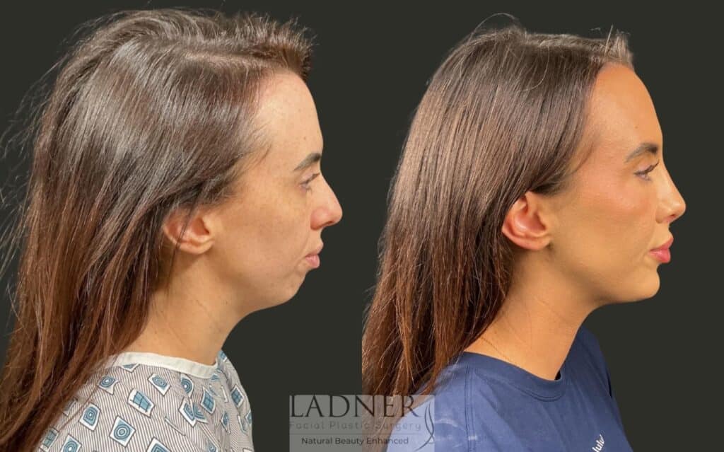 Before and After Image: Chin Augmentation & Rhinoplasty - right-side