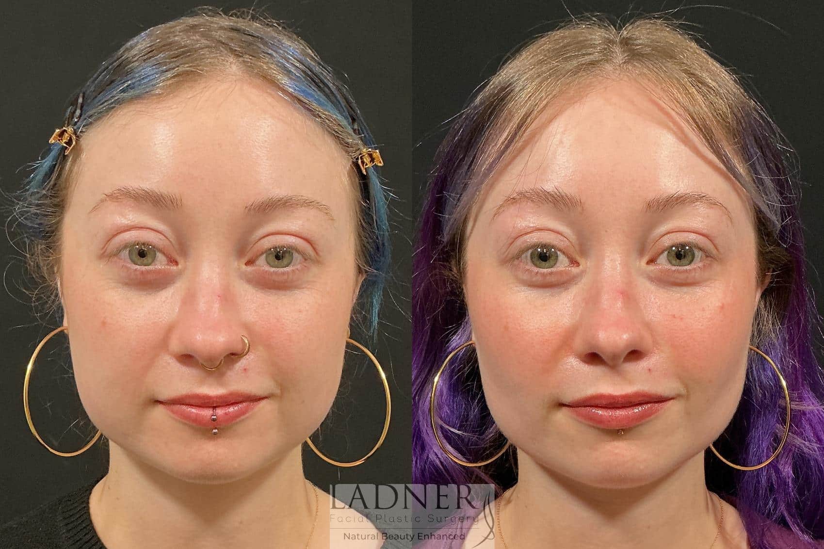 Before and After Image: Buccal Fat Removal - front