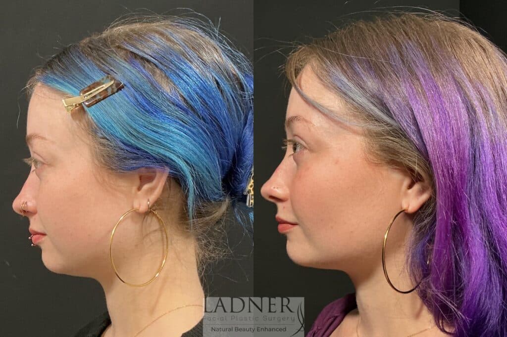 Before and After Image: Buccal Fat Removal - left-side