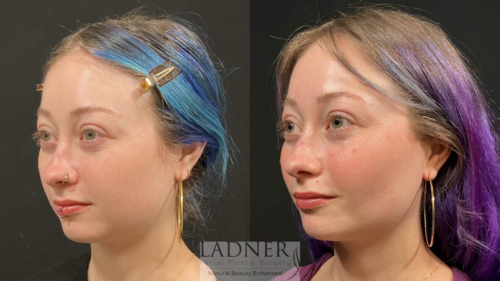 Before and After Image: Buccal Fat Removal - left-front-oblique