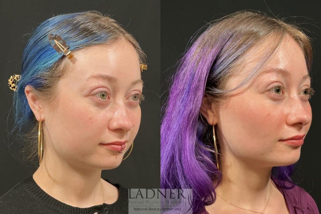 Before and After Image: Buccal Fat Removal - right-front-oblique