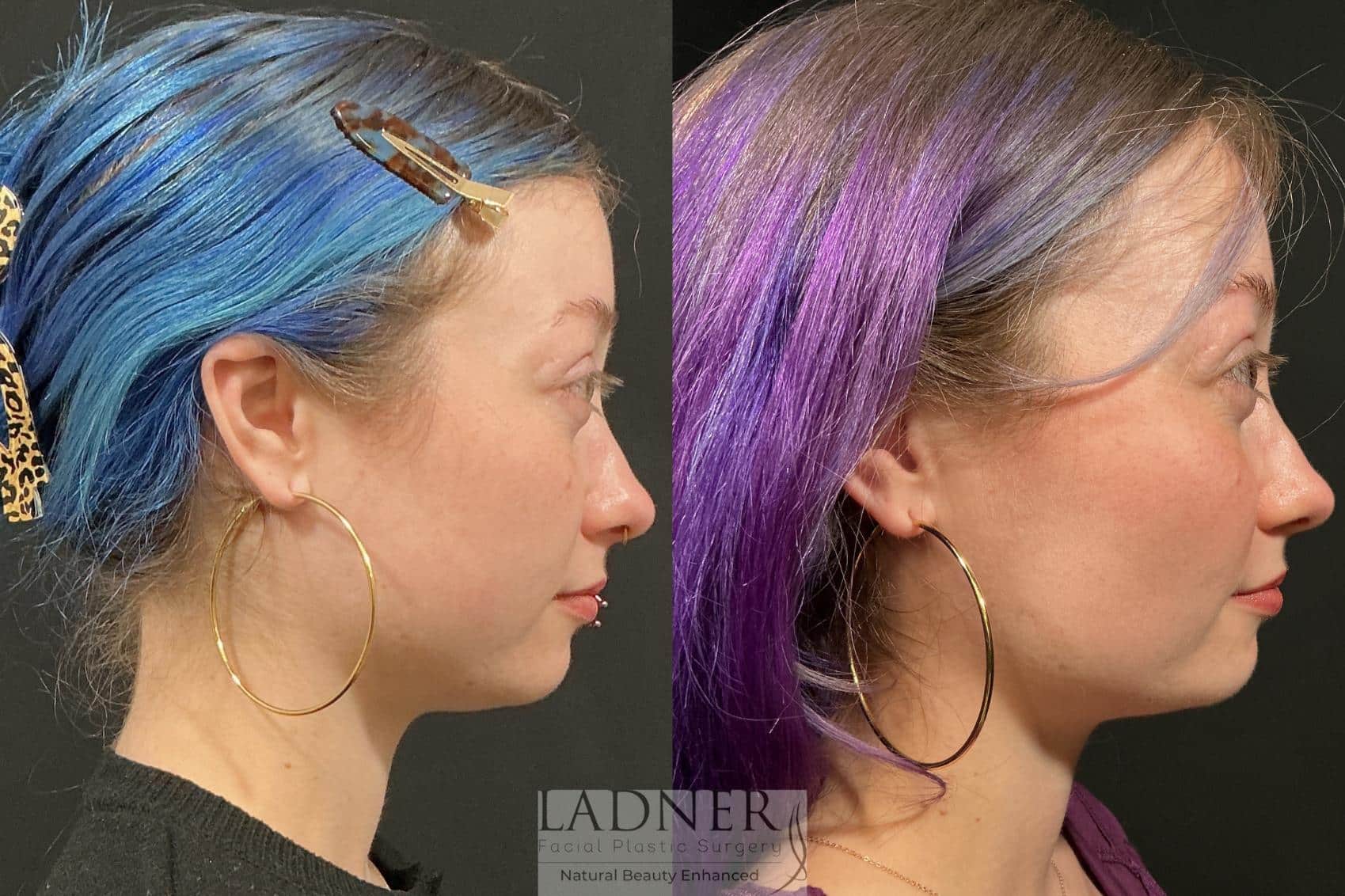 Before and After Image: Buccal Fat Removal - right-side