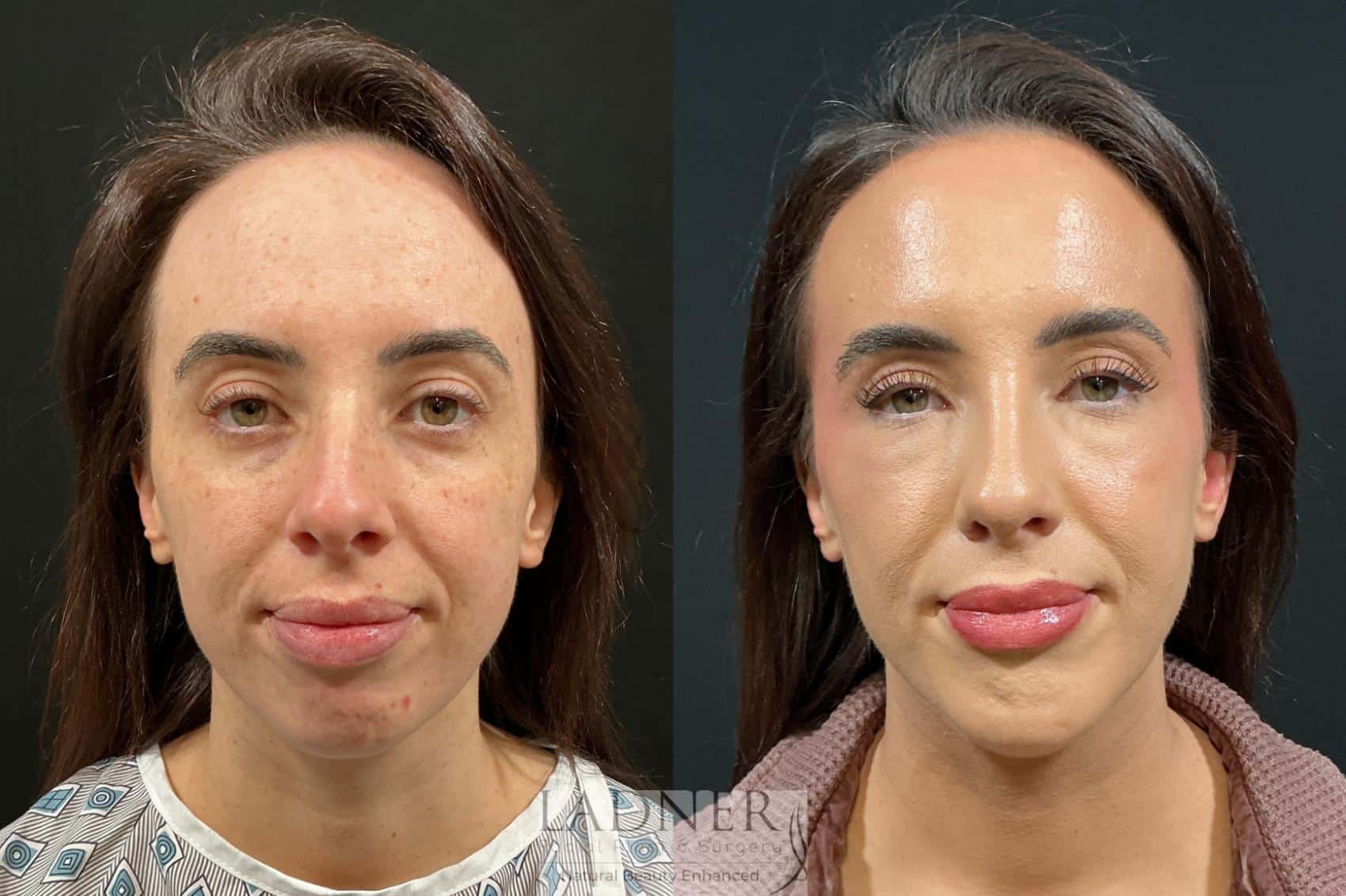 Before and After Image: Chin Augmentation & Rhinoplasty - front