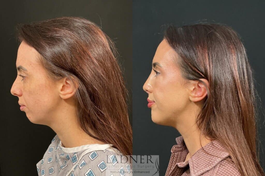 Before and After Image: Chin Augmentation & Rhinoplasty - left-side