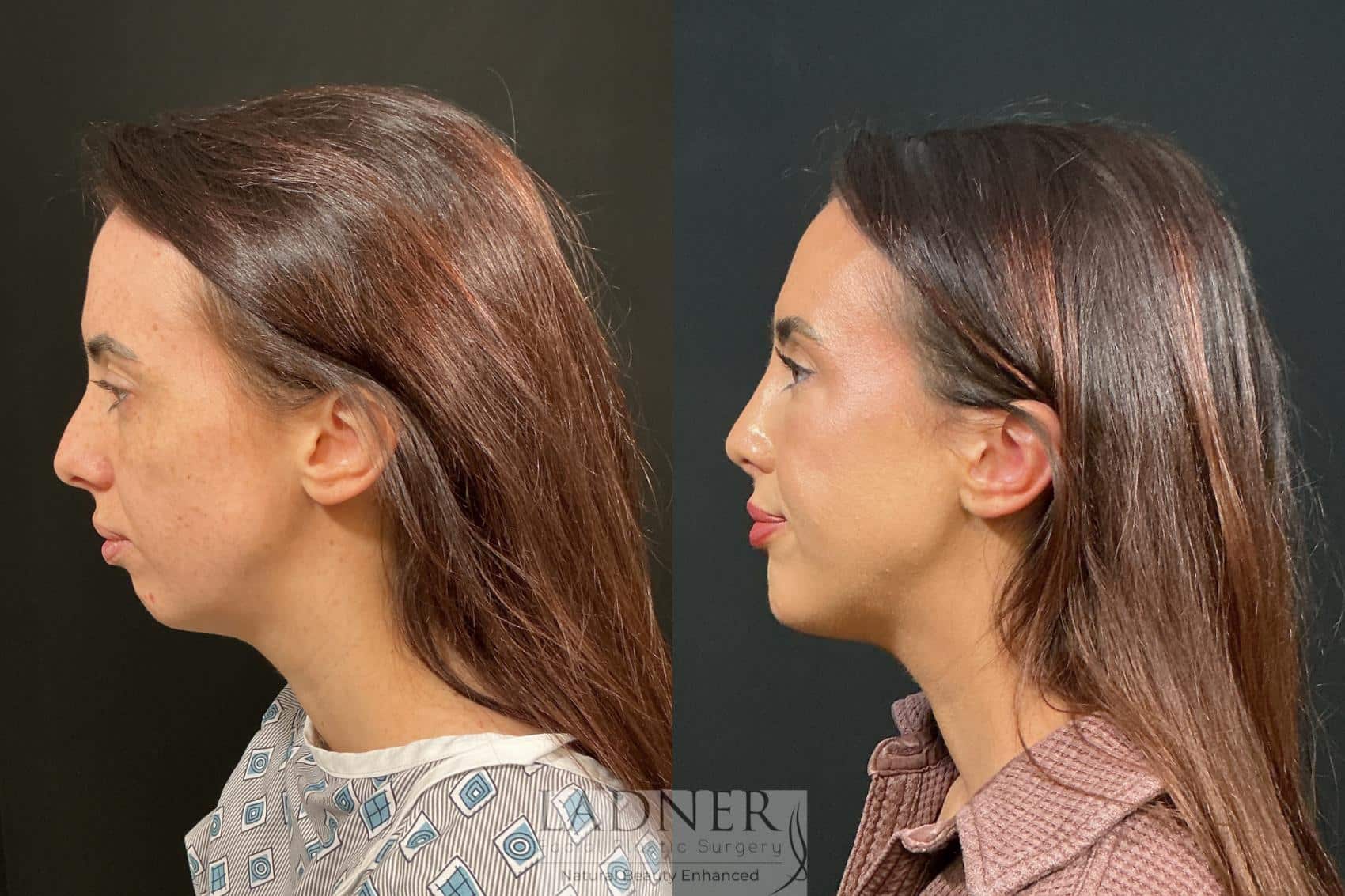 Before and After Image: Chin Augmentation & Rhinoplasty - left-side