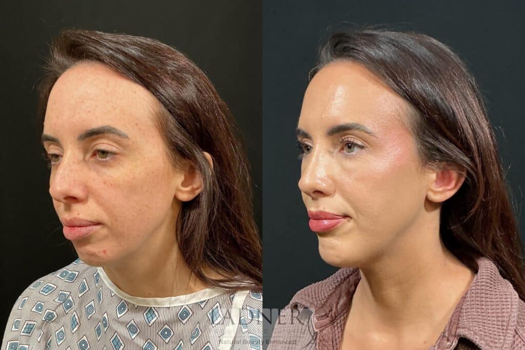 Before and After Image: Chin Augmentation & Rhinoplasty - left-front-oblique
