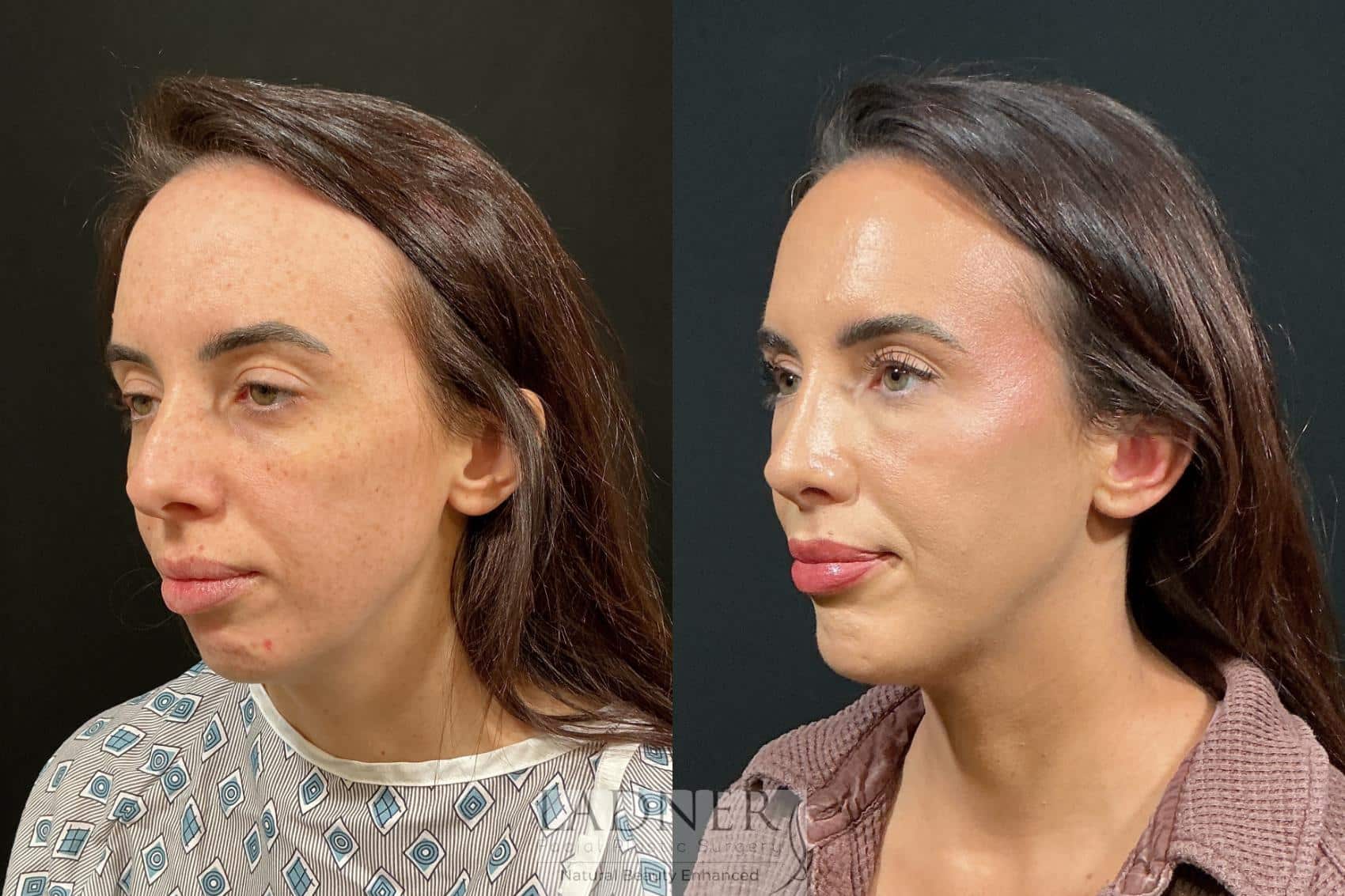 Before and After Image: Chin Augmentation & Rhinoplasty - left-front-oblique