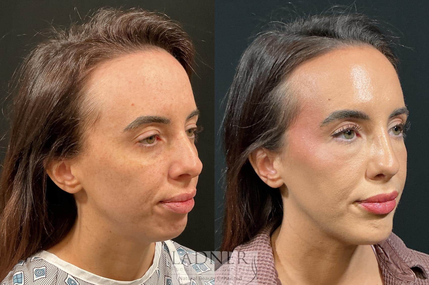 Before and After Image: Chin Augmentation & Rhinoplasty - right-front-oblique