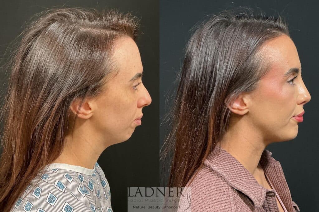 Before and After Image: Chin Augmentation & Rhinoplasty - right-side