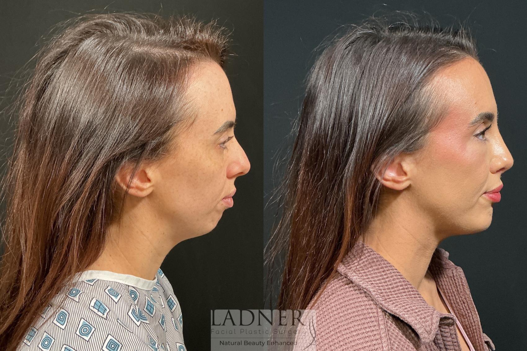 Before and After Image: Chin Augmentation & Rhinoplasty - right-side