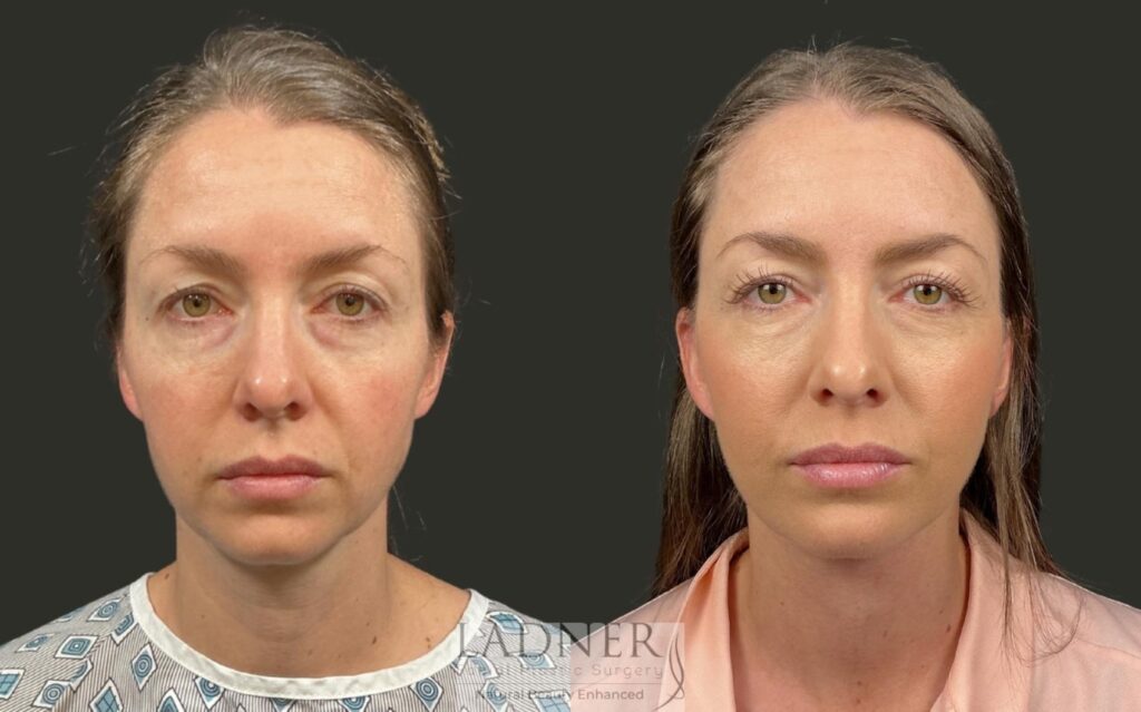 Before and After Image: Deep Plane Lower Facelift / Deep Plane Neck Lift - front
