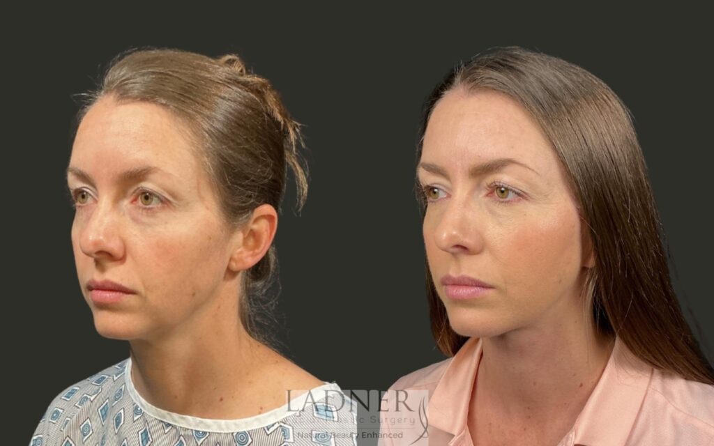 Before and After Image: Deep Plane Lower Facelift / Deep Plane Neck Lift - left-front-oblique