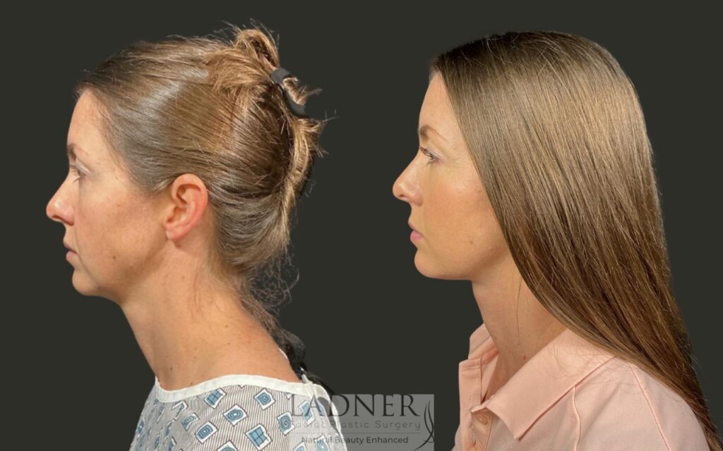 Before and After Image: Deep Plane Lower Facelift / Deep Plane Neck Lift - left-side