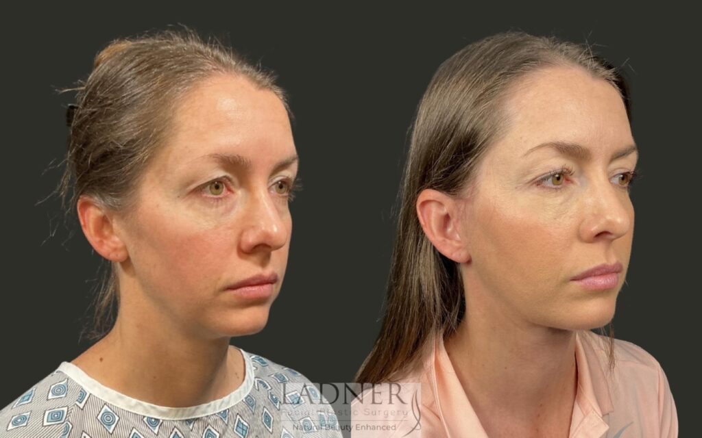 Before and After Image: Deep Plane Lower Facelift / Deep Plane Neck Lift - right-front-oblique
