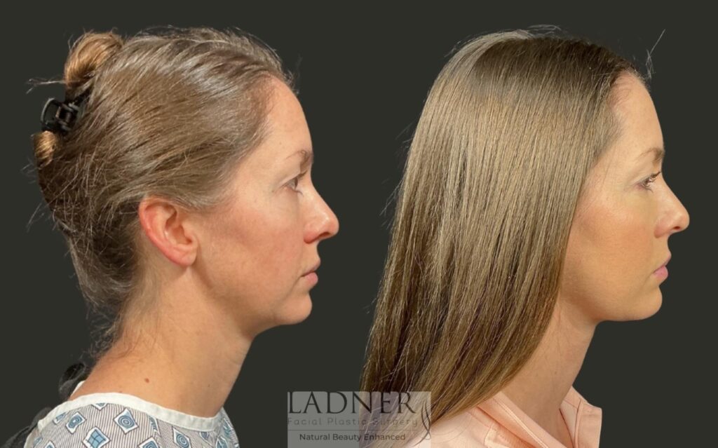 Before and After Image: Deep Plane Lower Facelift / Deep Plane Neck Lift - right-side