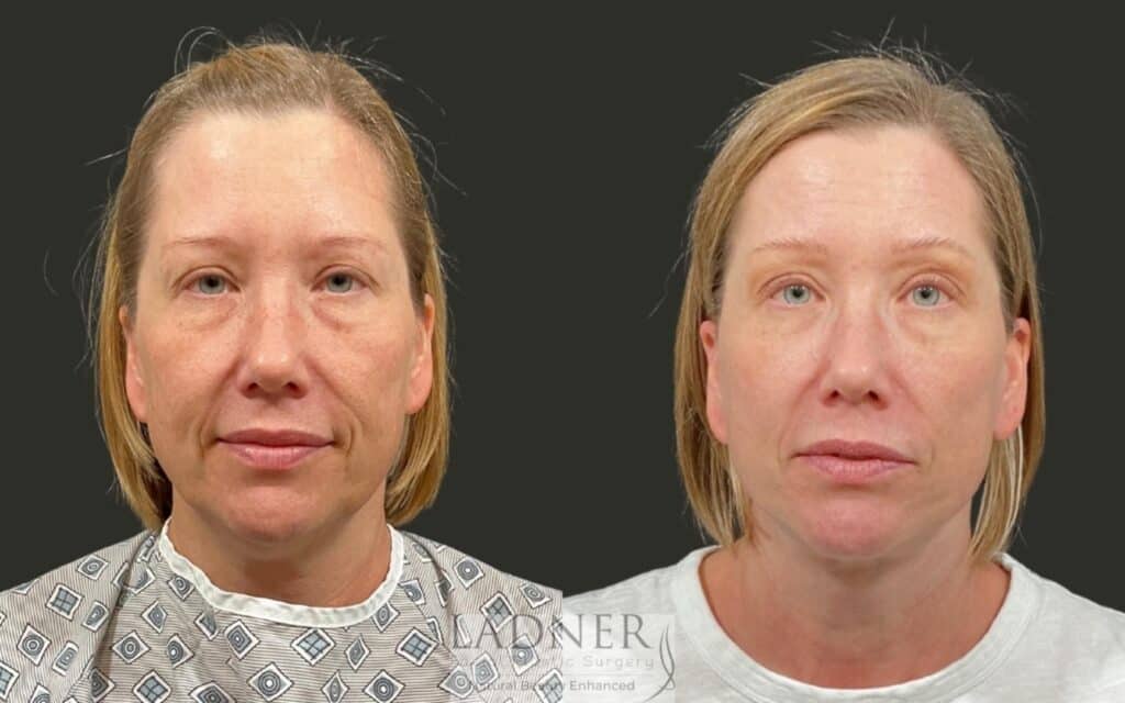 Before and After Image: Deep Plane Lower Facelift/Necklift - front