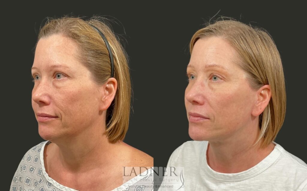 Before and After Image: Deep Plane Lower Facelift/Necklift - left-front-oblique
